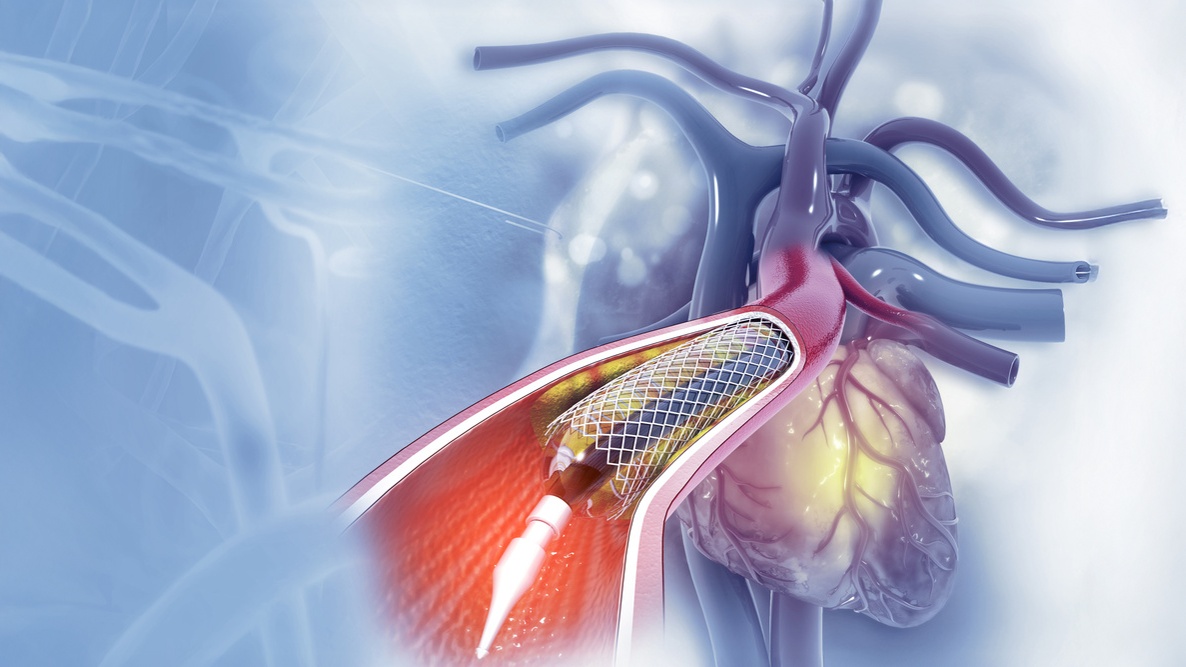 angioplastia