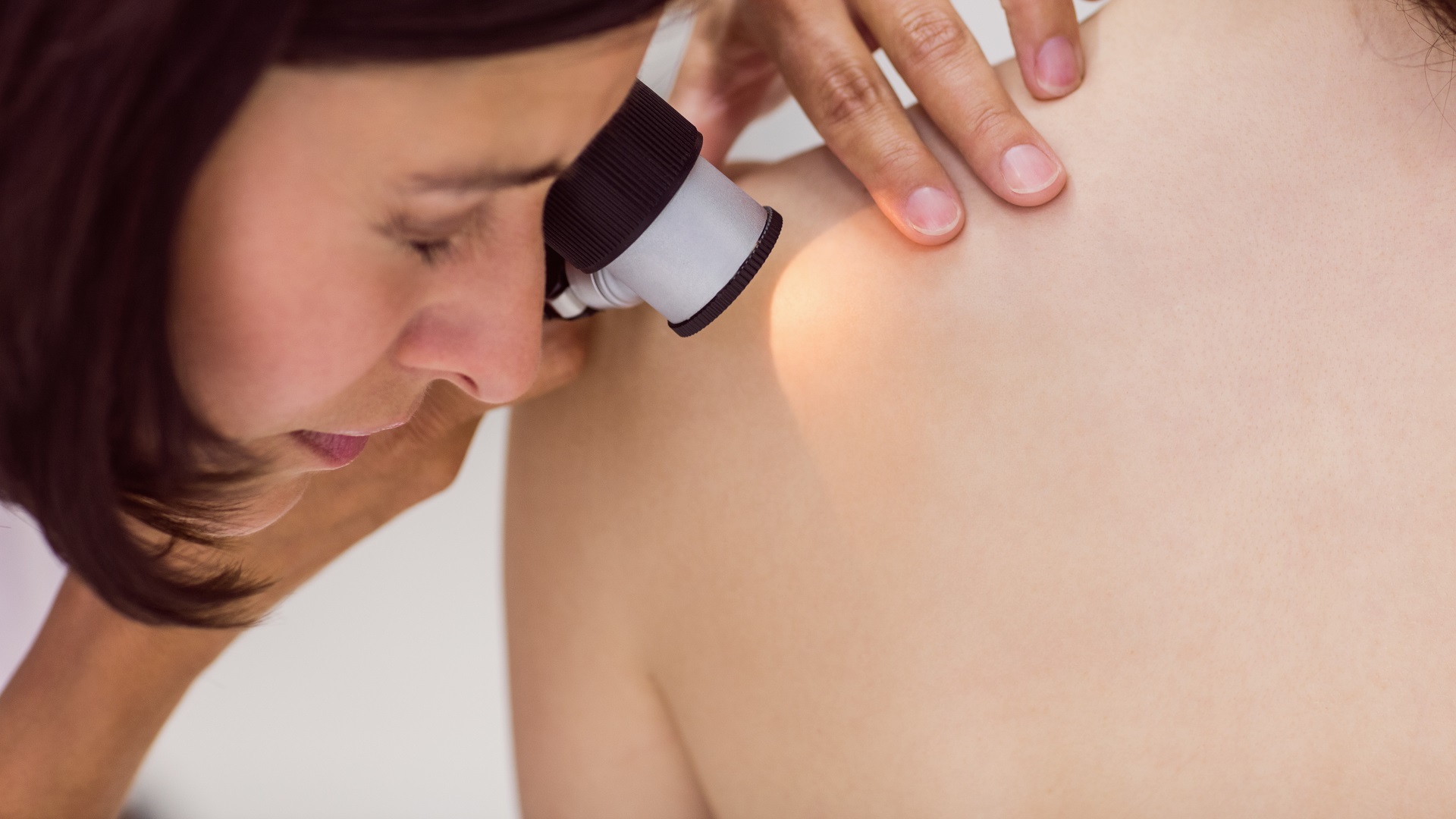 Caso clínico: Dermatoscopia ajuda no diagnóstico de doença do tecido conjuntivo? 