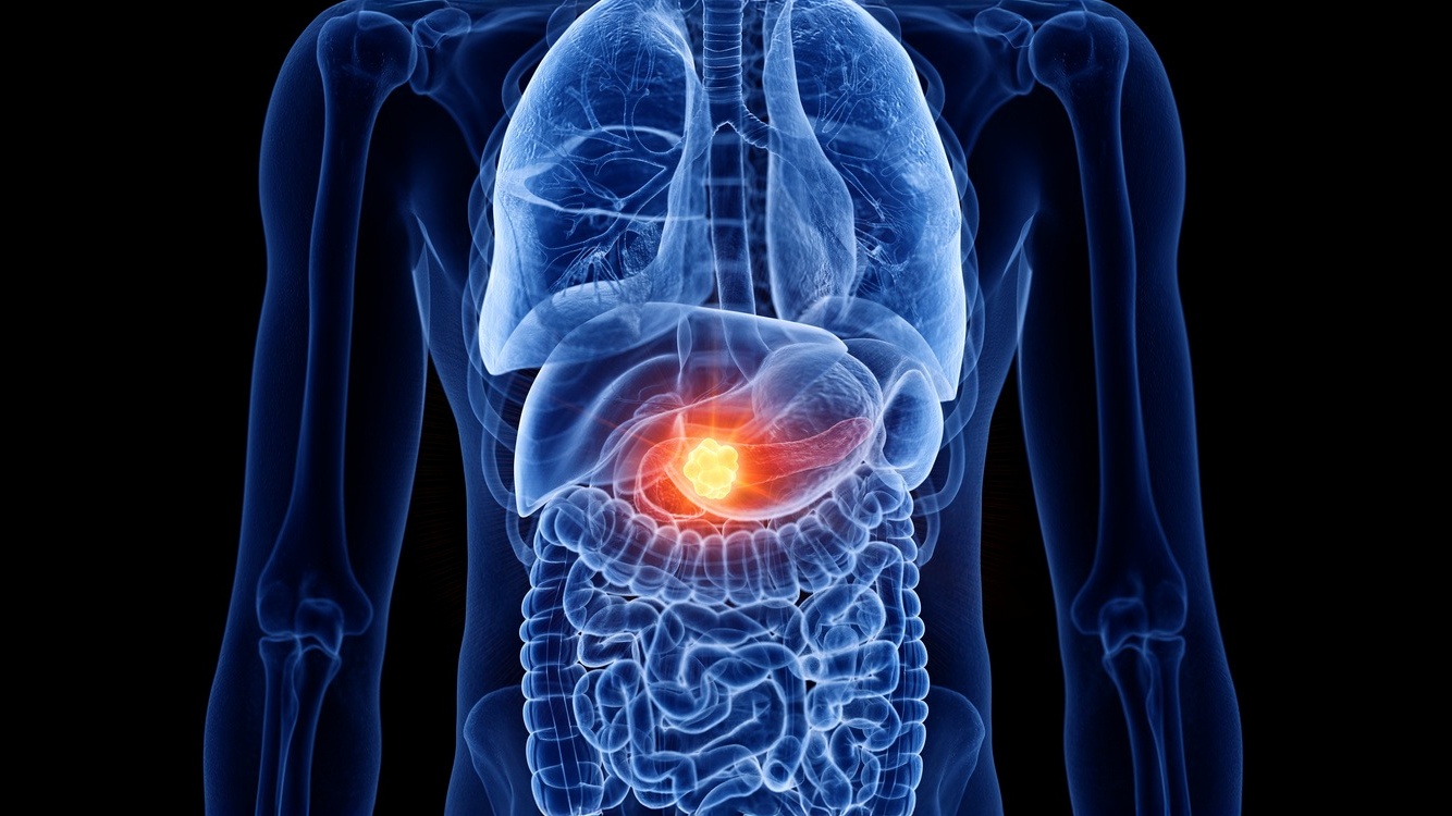 Adénocarcinome métastatique du pancréas : existe-t-il une chance de traitement curatif ?