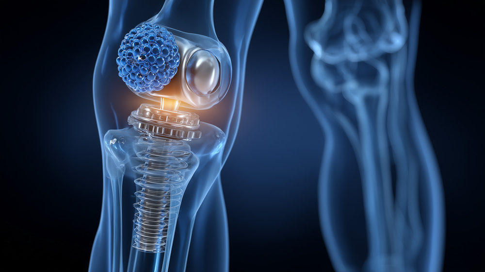 infecção aguda da prótese