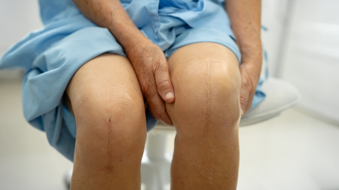 artroplastia total de joelho