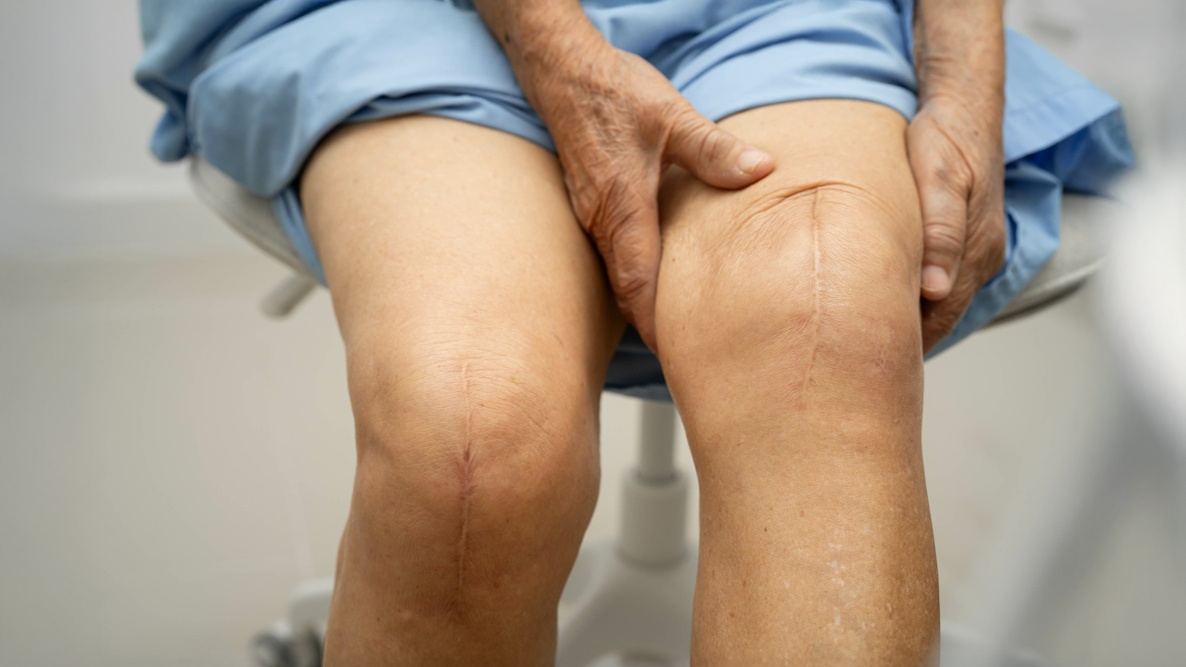 risco de trombose após artroplastia