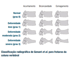 Fig. 1. Classificação radiográfica de Genant et al. para fraturas da coluna vertebral