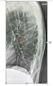 Identificação de fraturas vertebrais em uma radiografia.