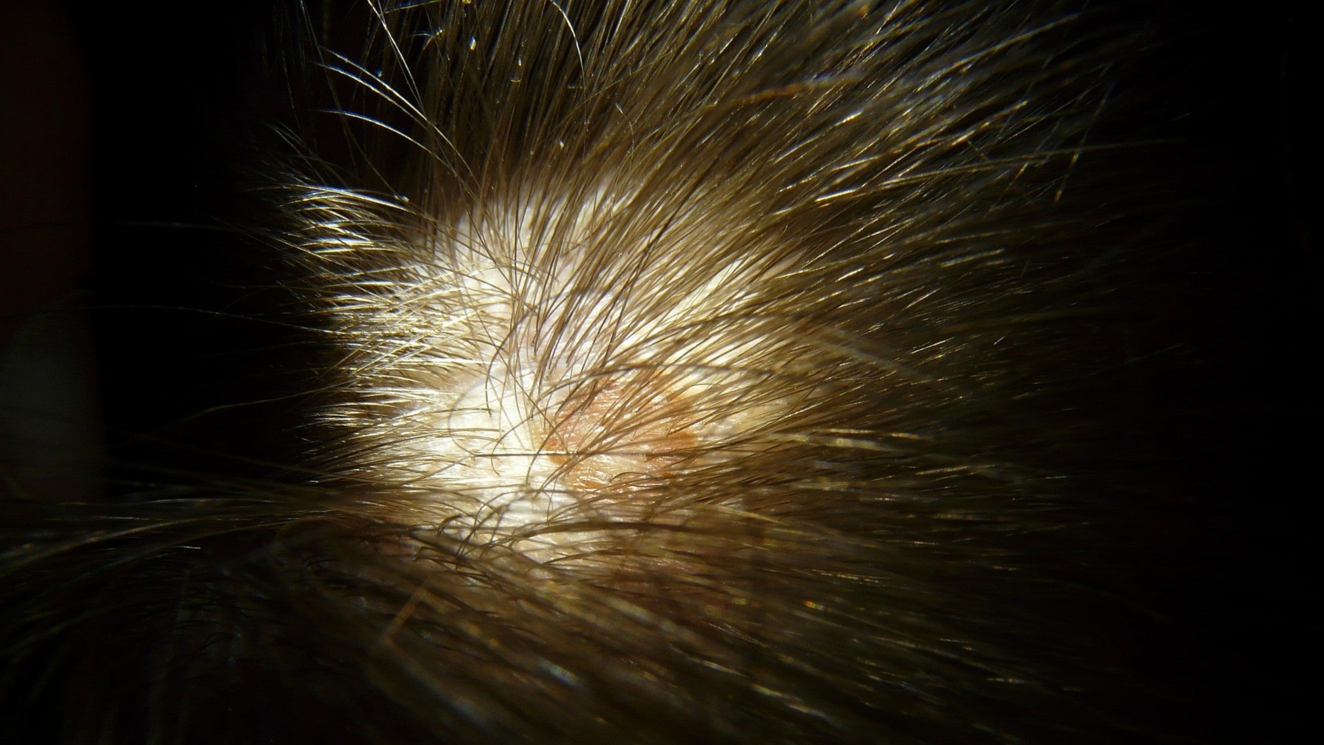 Caso clínico: Escamas grossas no couro cabeludo, qual o diagnóstico? 