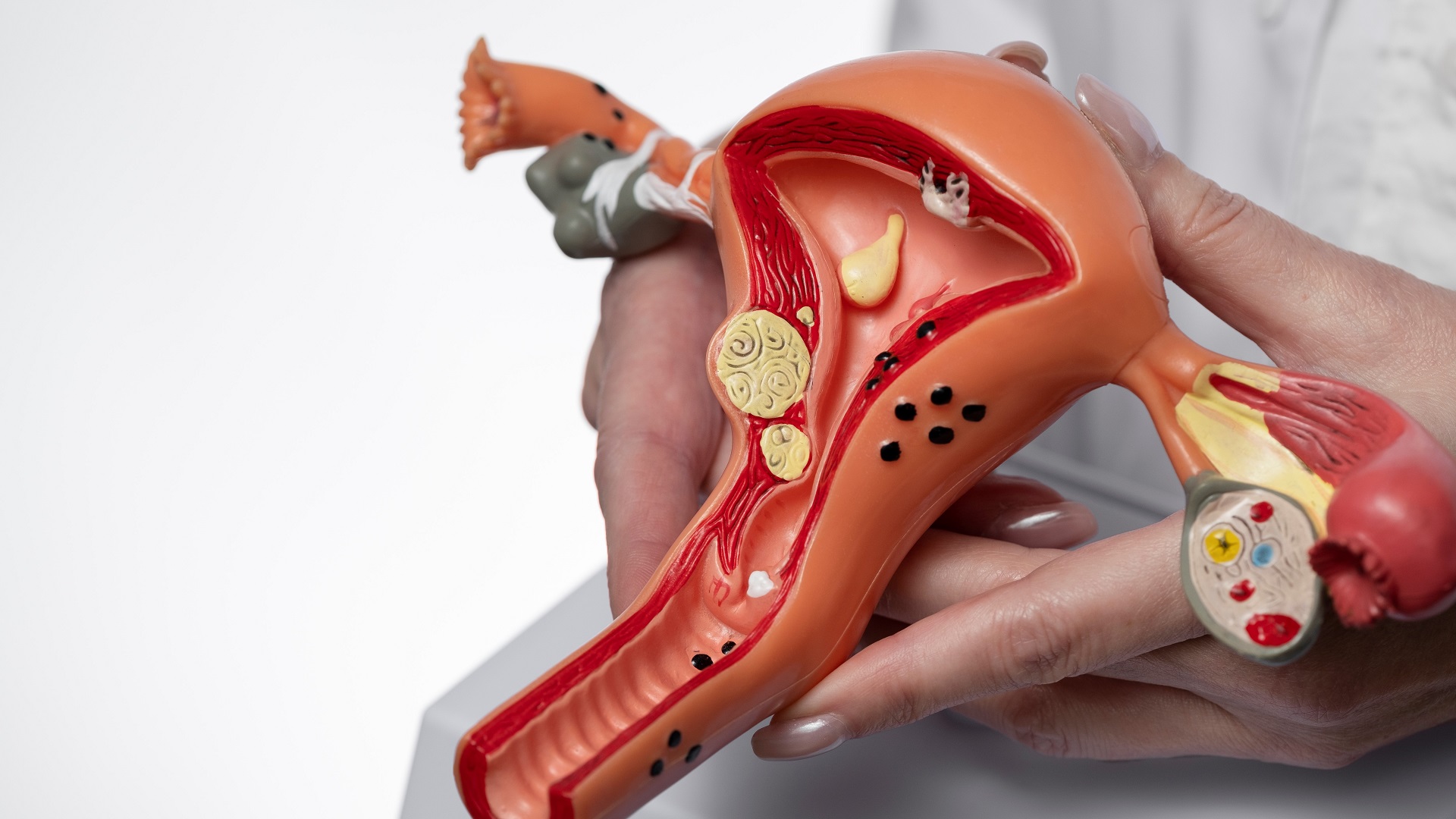 Miomectomia em miomas intramurais antes da FIV: o que dizem as evidências atuais? 