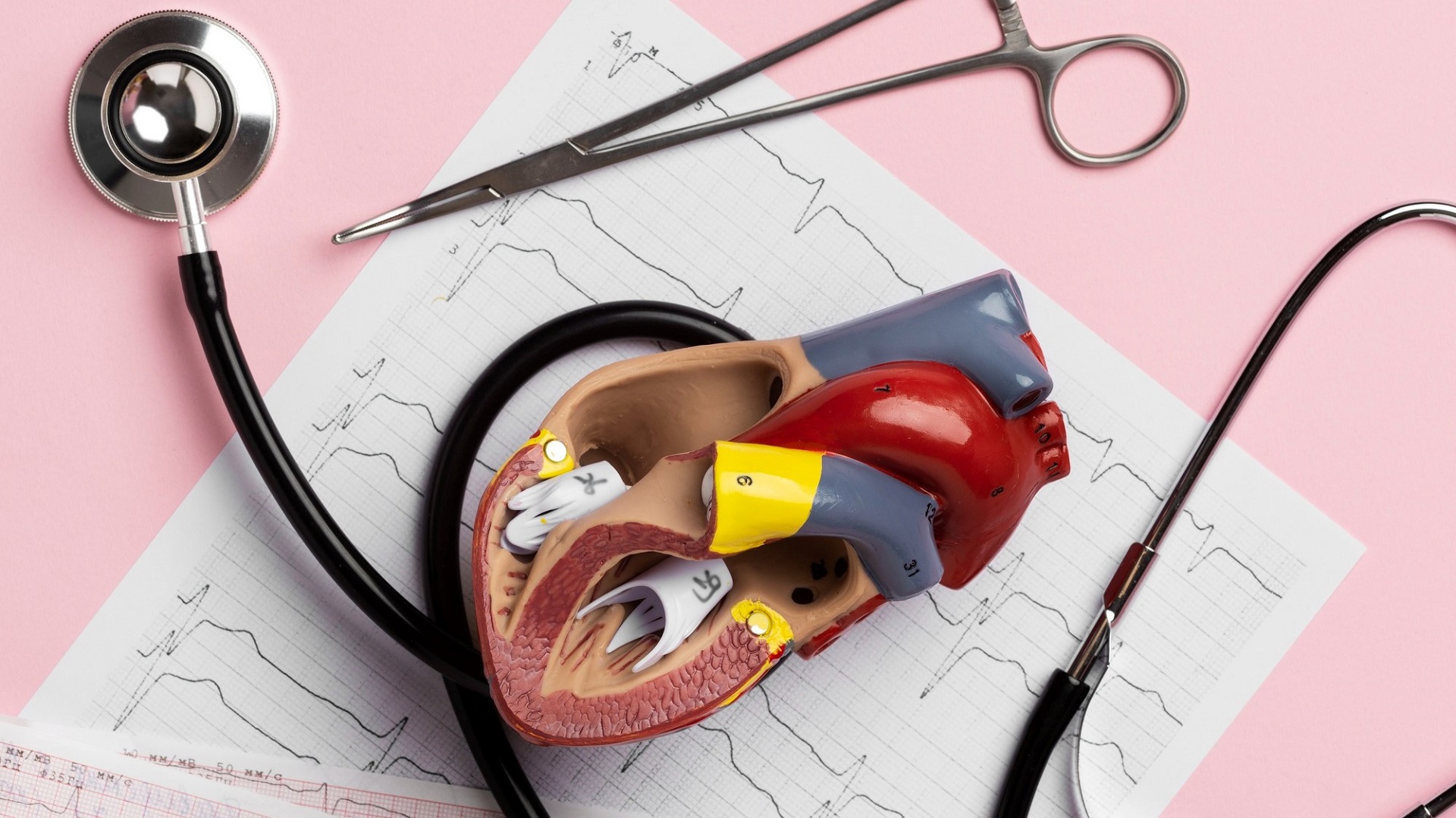 Angioplastia imediata x estagiada de lesões não culpadas no IAMCST 