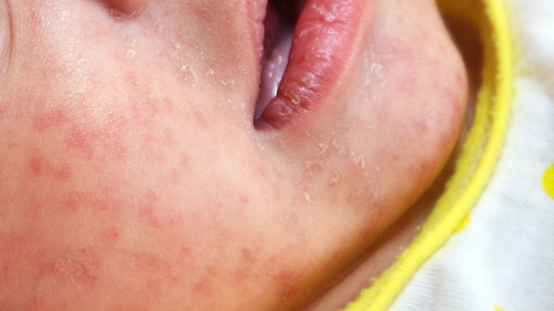 Estado de São Paulo emite alerta para sarampo durante temporada de cruzeiros