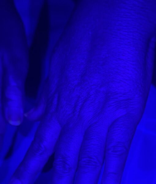 Exame com a luz de Wood