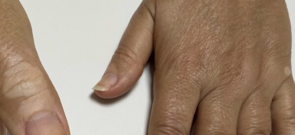 Manchas hipocrômicas no dorso do 1º quirodáctilo direito e dorso da mão próximo ao 5º quirodáctilo esquerdo