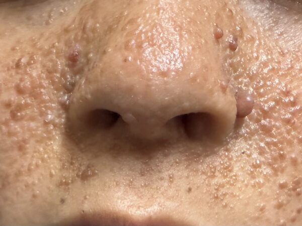 Pápulas em torno do nariz 