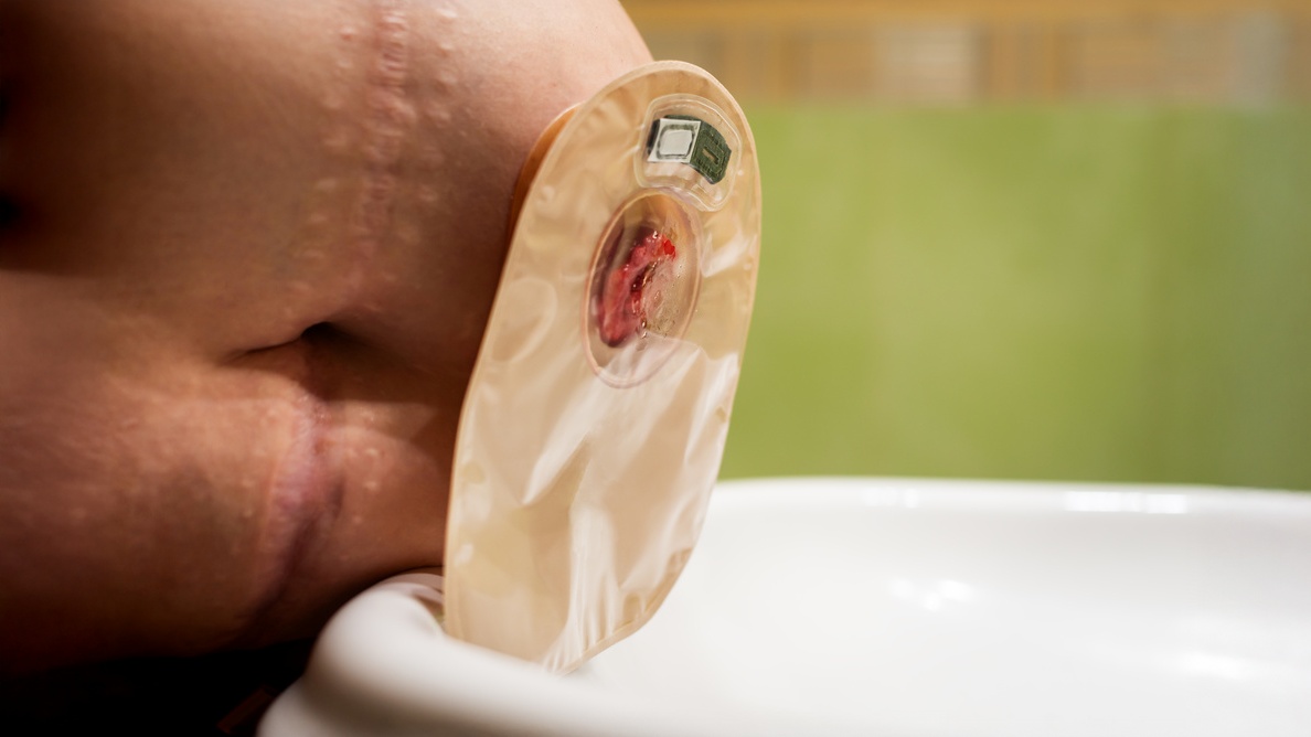 obstrução de estomas