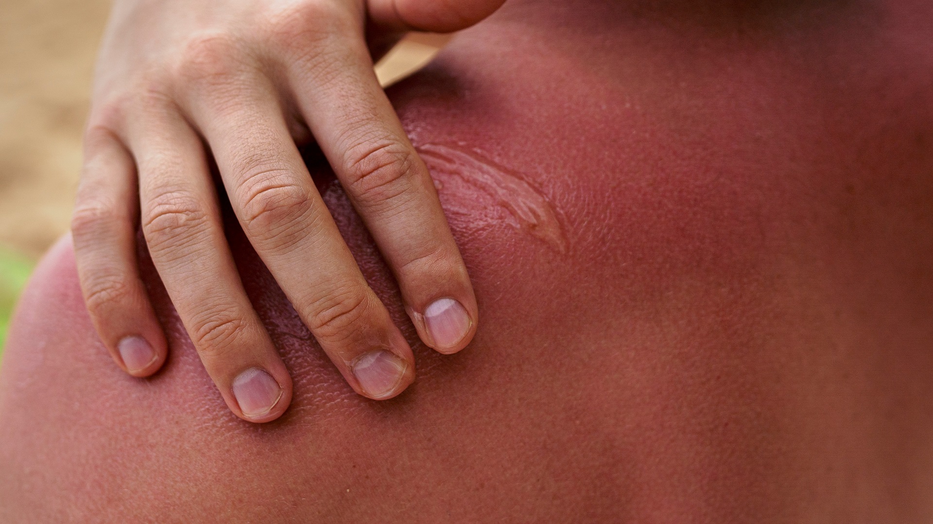 Existe relação entre as queimaduras solares e o carcinoma espinocelular?