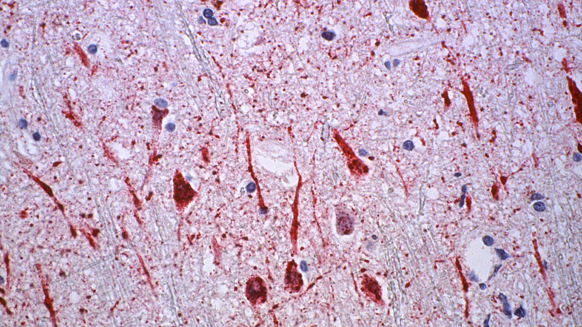 Vírus Nipah: o que o médico deve saber? 