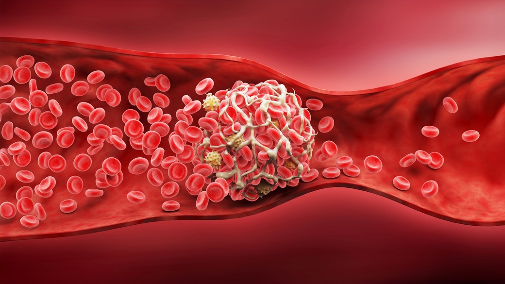trombose associada ao câncer