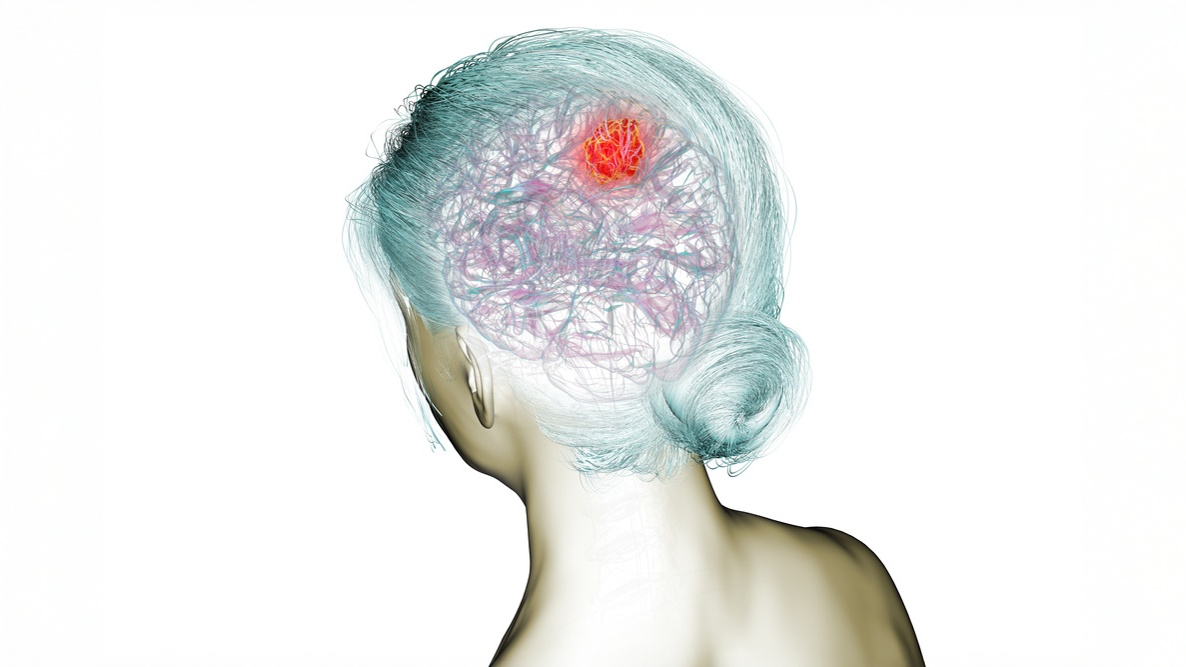 metástase leptomeníngea câncer de pulmão