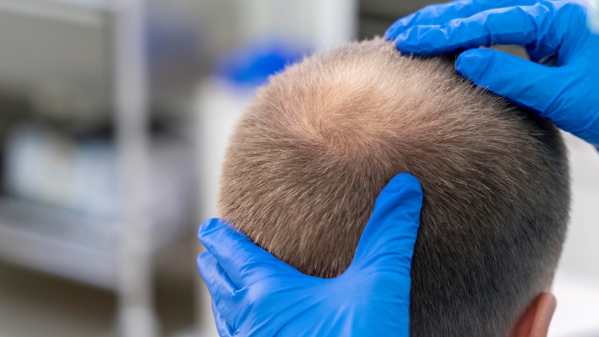 Alopecia areata: como promover o bem-estar nos pacientes? 