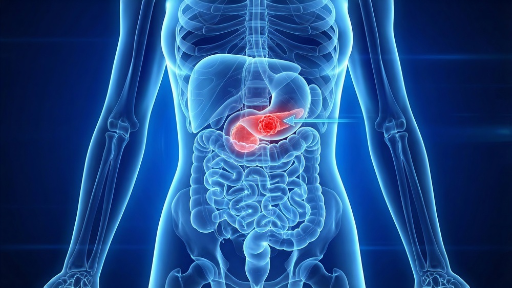 colecistomia na colecistite aguda