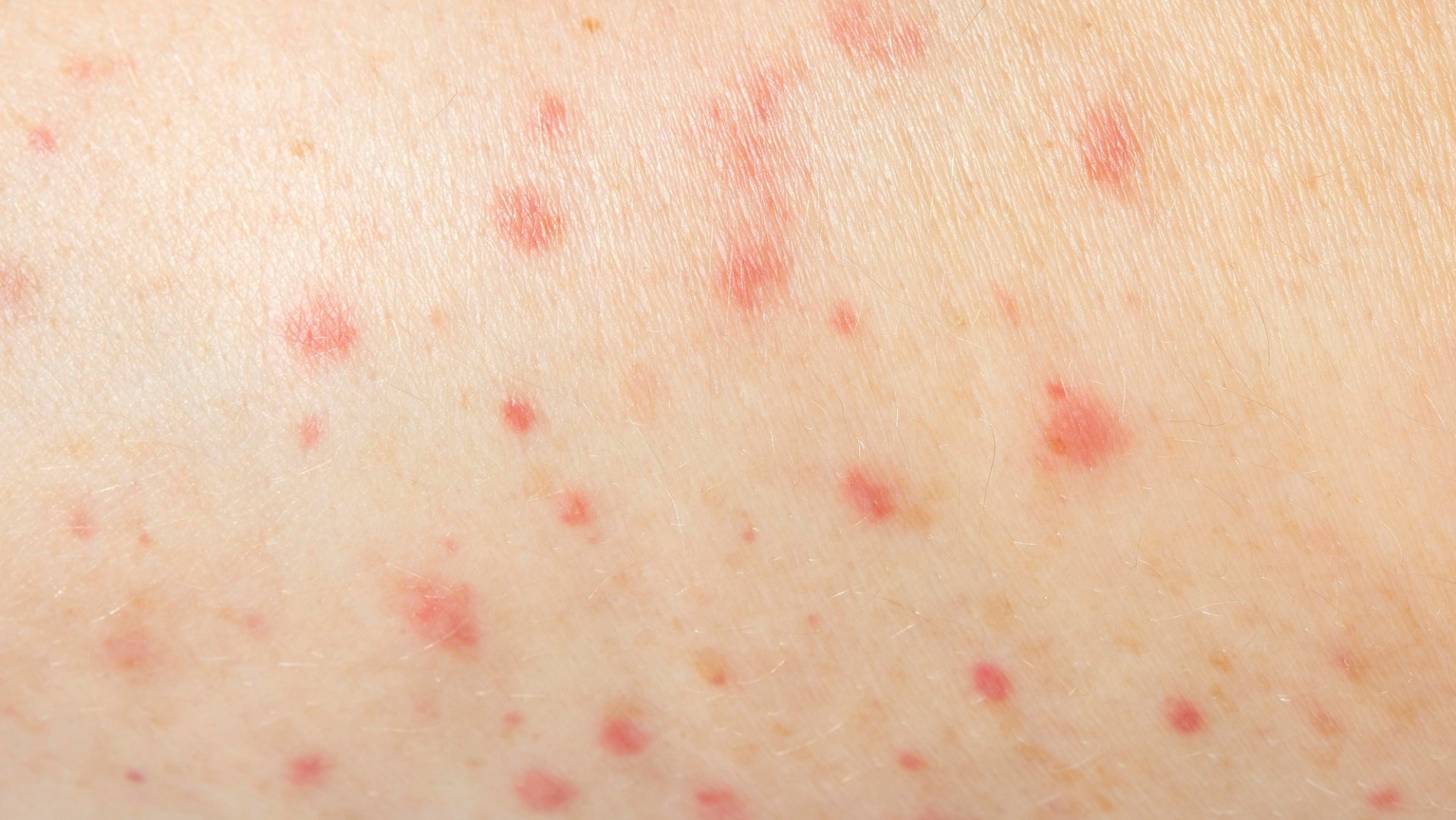 São Paulo registra primeiro caso de sarampo no Brasil em 2026