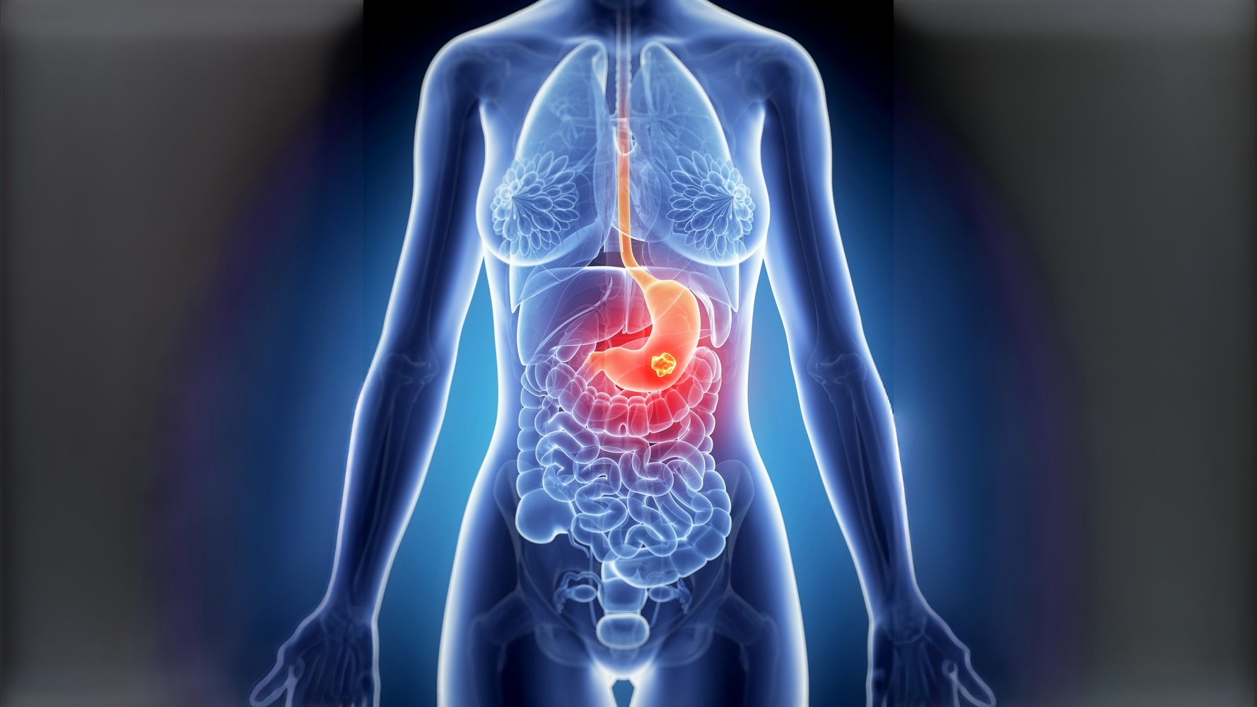 asco 2026 imunoterapia câncer gastroesofágico