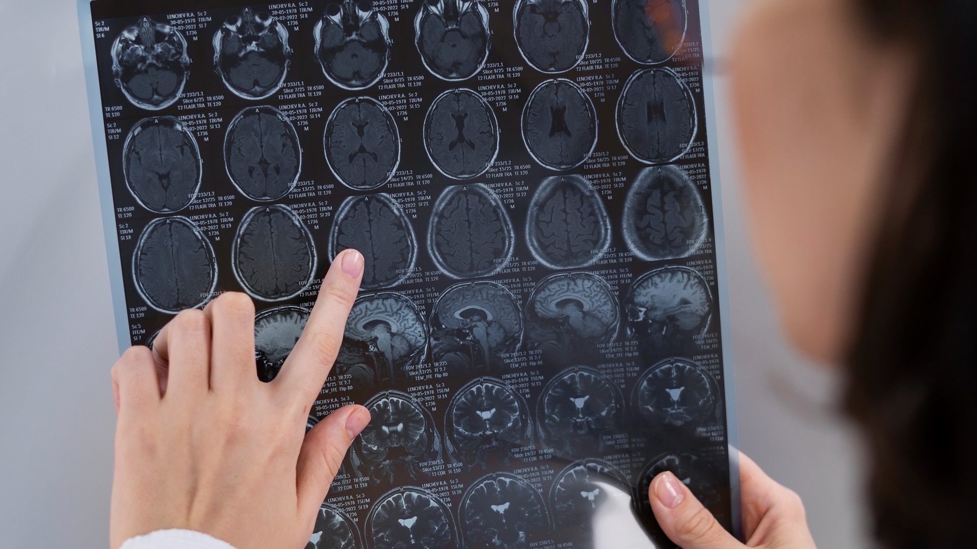 MOGAD Pediátrica: sinal da veia central e halo paramagnético no diagnóstico