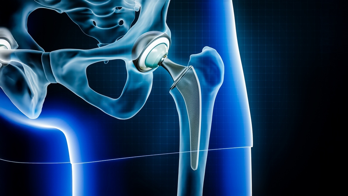 artroplastia de quadril