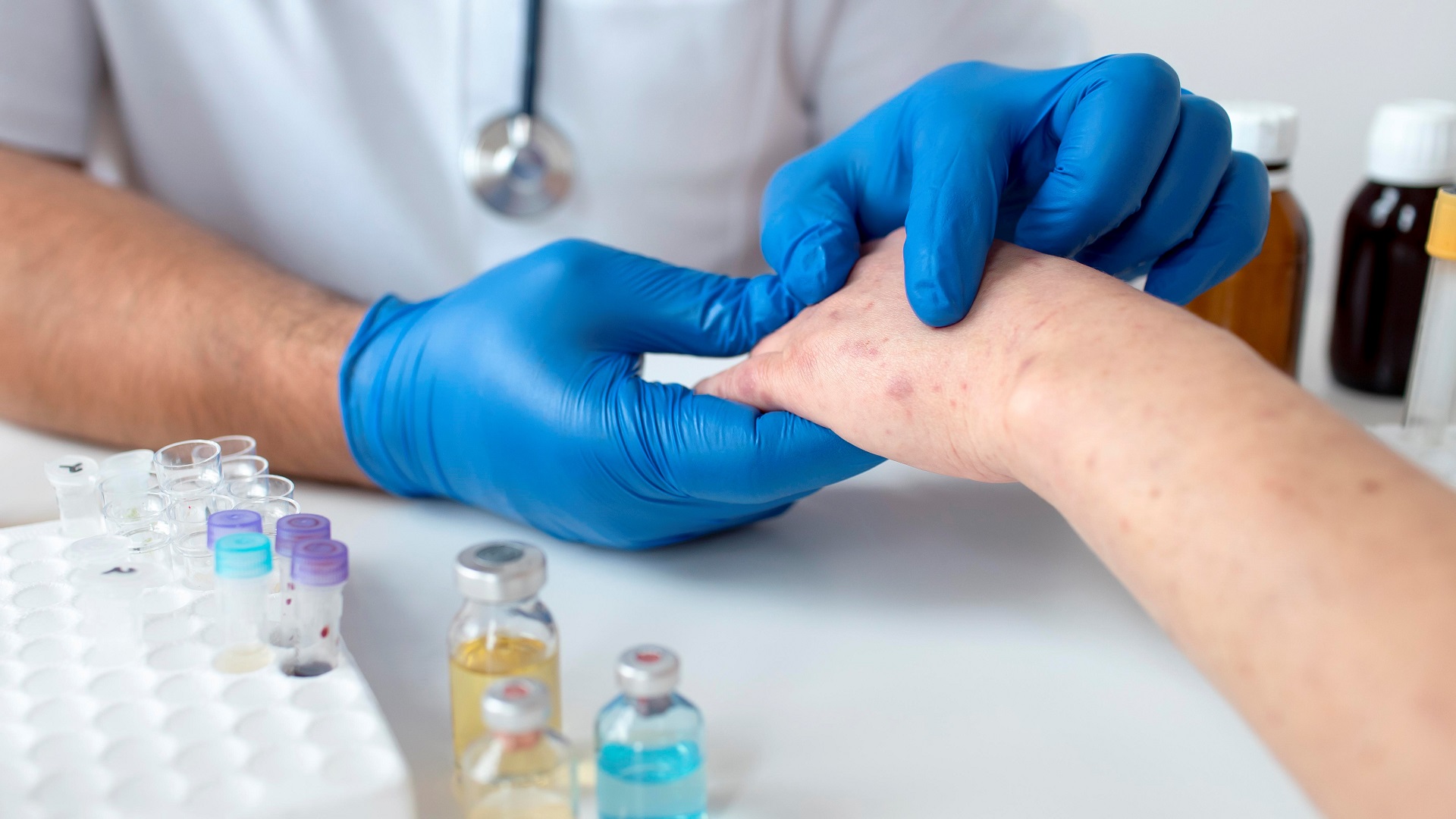 Esporotricose: uma micose negligenciada com impacto mundial