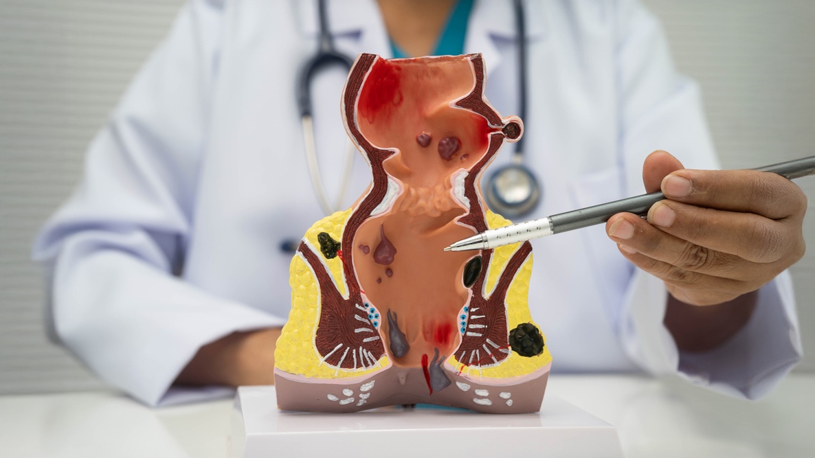 cirurgia de hemorroida