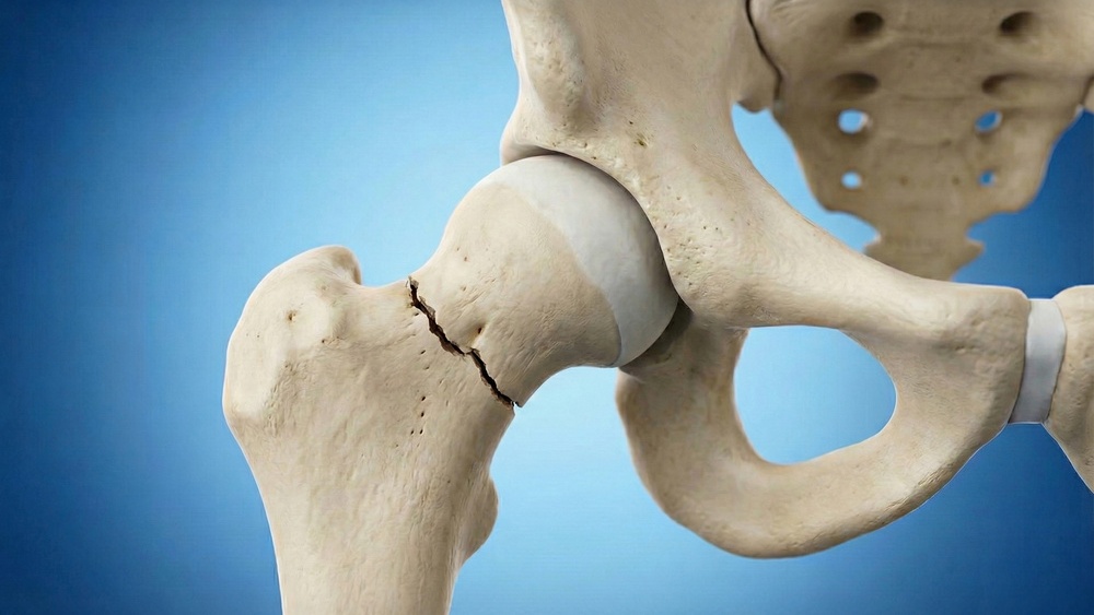osteoporose após fratura do colo do fêmur