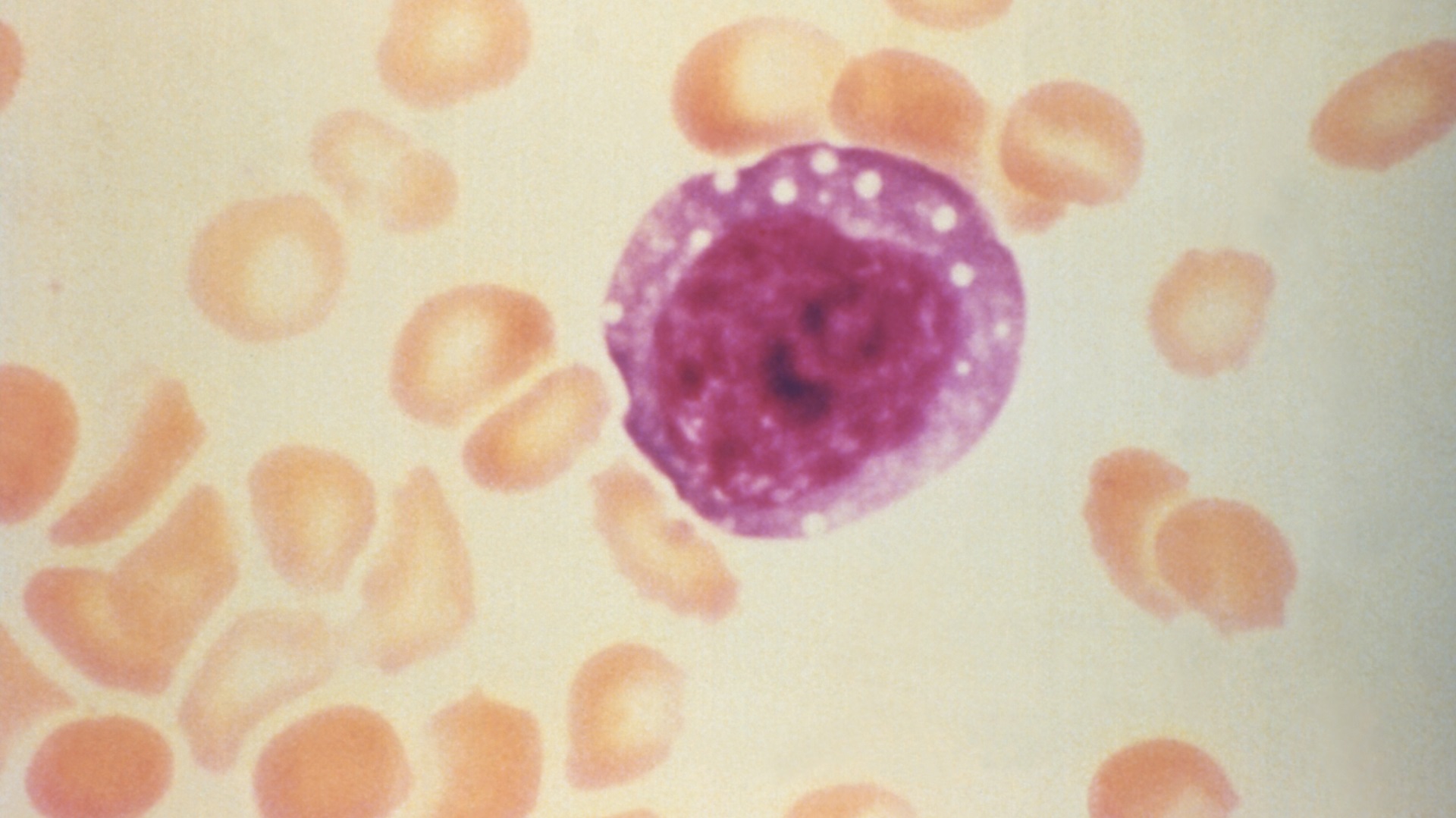 Linfócito atípico e aumentado encontrado em um esfregaço sanguíneo de um paciente com síndrome pulmonar por hantavírus (SPH). Imagem de CDC/ Dr. Sherif R. Zaki