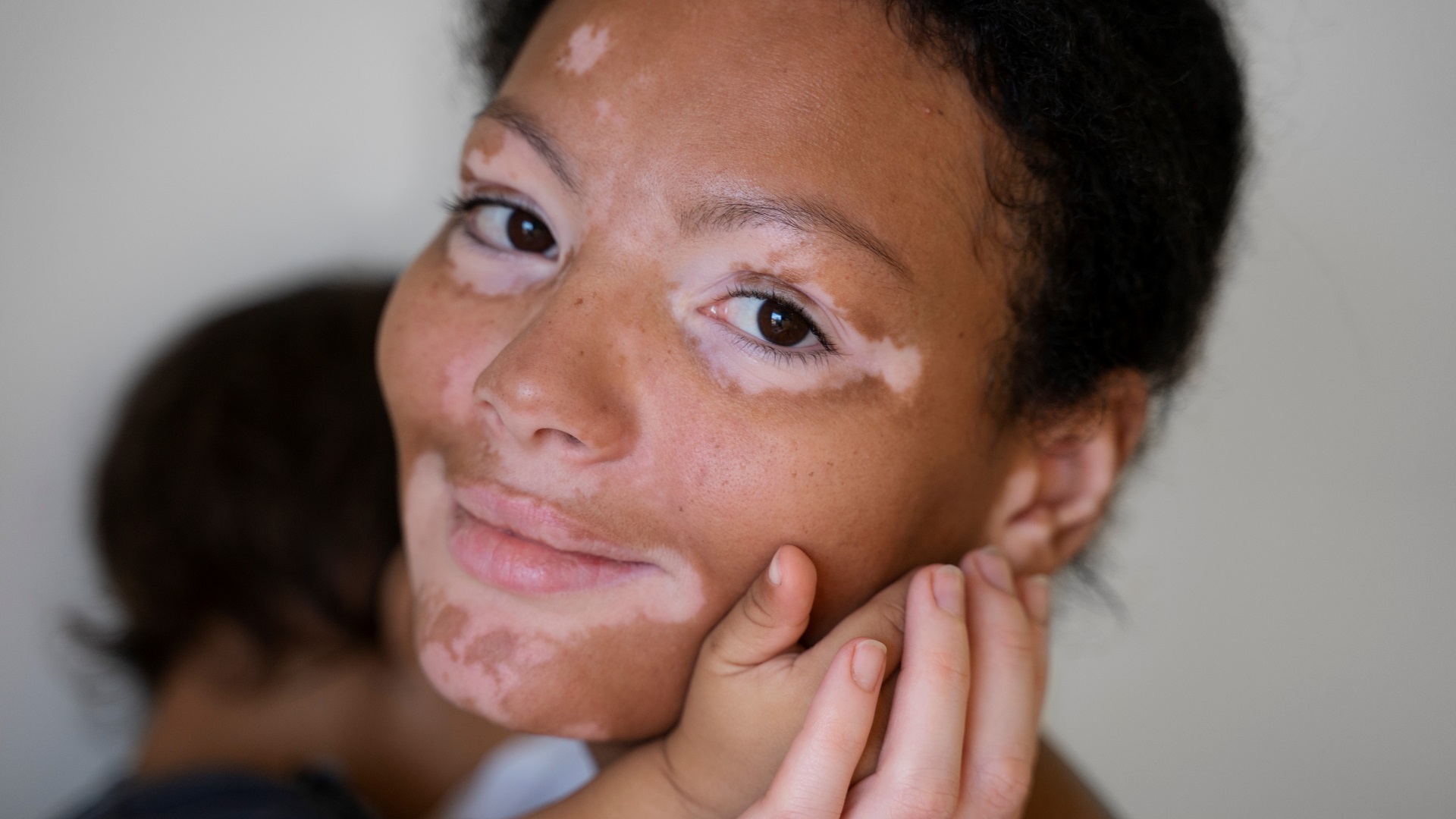 Vitiligo: Revisão sistemática avaliou crenças interculturais e estigmatização 