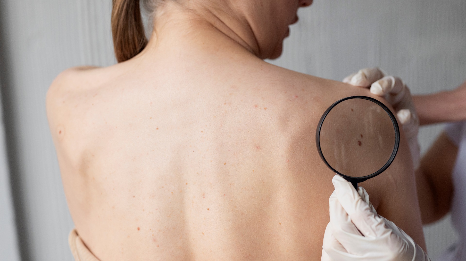 CEC e células de Merkel: Avanços na dermatopatologia e medicina de precisão