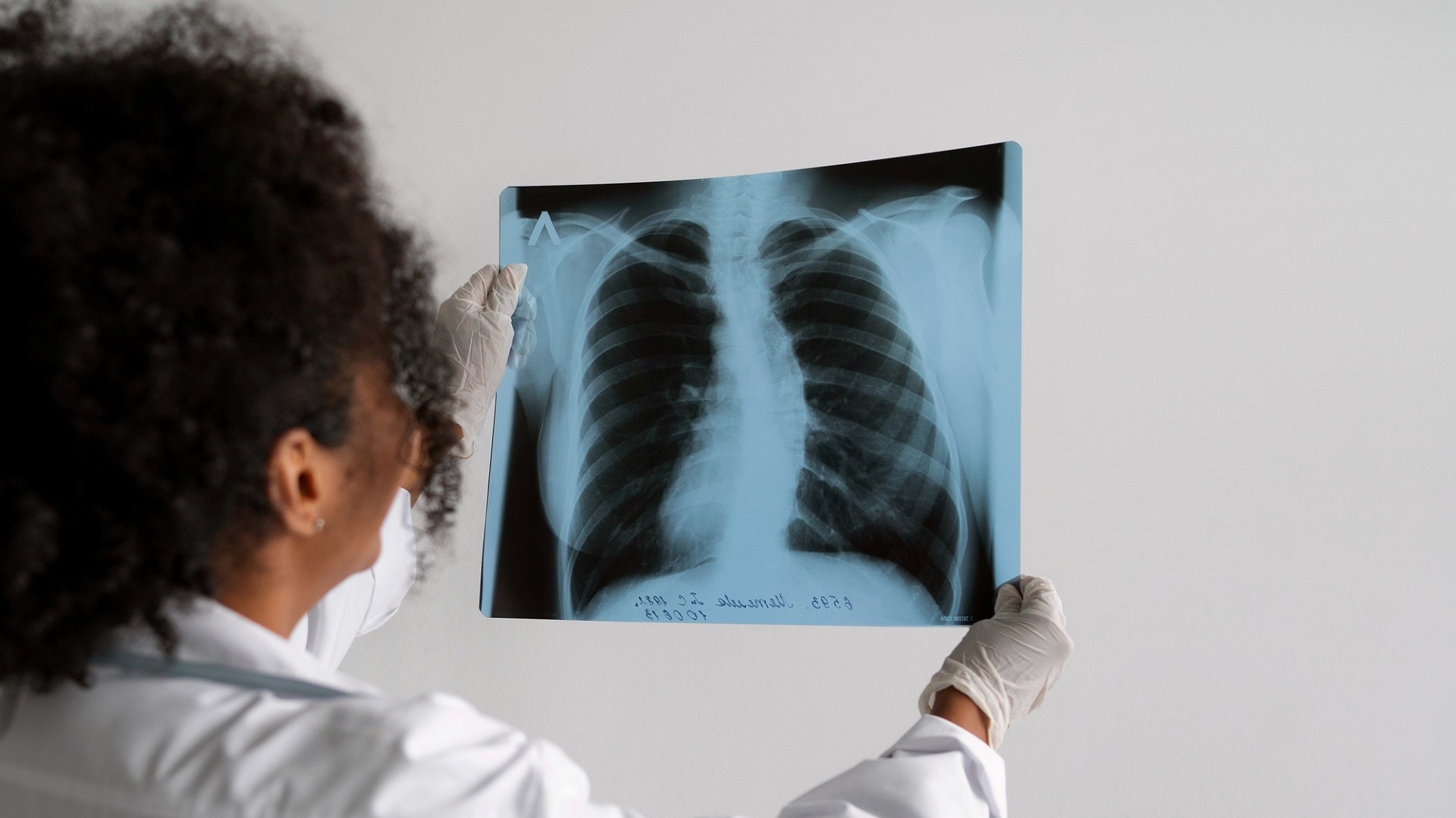 Anvisa amplia uso de imunoterapia com Tislelizumabe para câncer de pulmão 