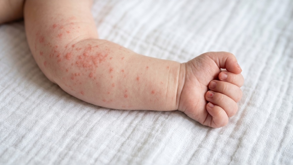 fórmula hidrolisada e prevenção de alergia infantil