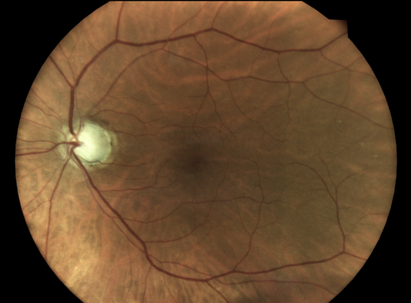 Imagem fundoscópica com aumento da escavação do disco óptico e afilamento do anel neurorretiniano.