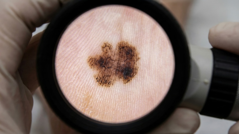 biópsia linfonodo melanoma