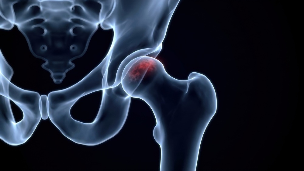 fraturas da cabeça femoral