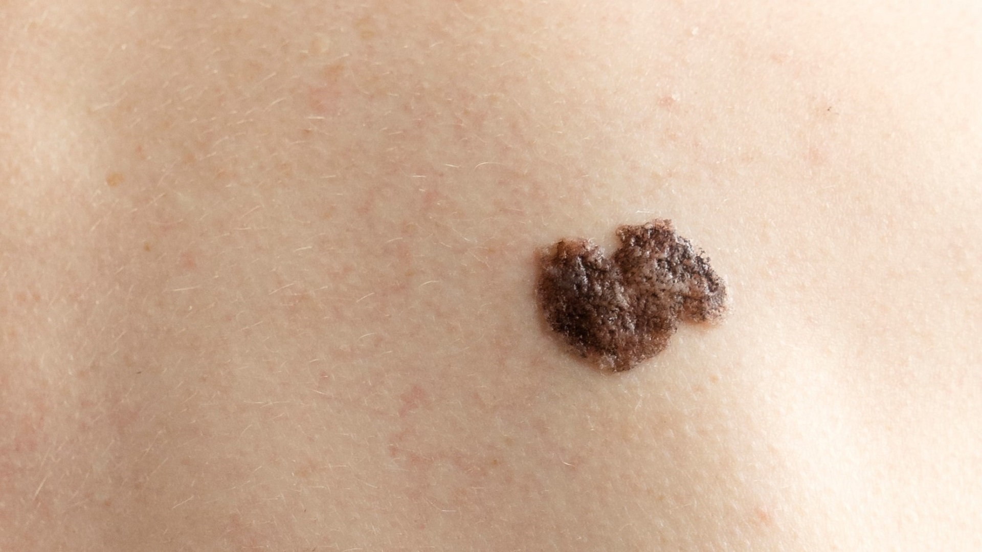 FDA aprova imunoterapia viral para melanoma resistente a PD-1 