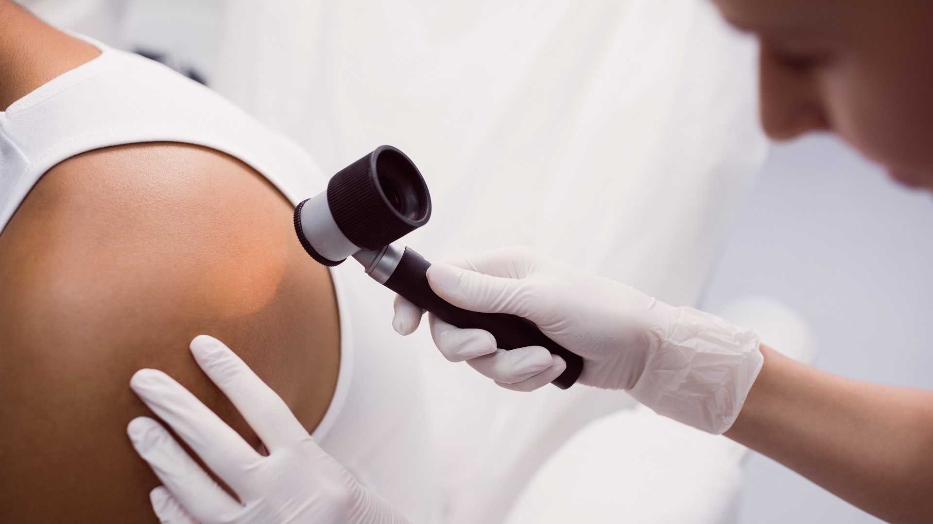Carcinoma basocelular pigmentado em fototipos mais altos