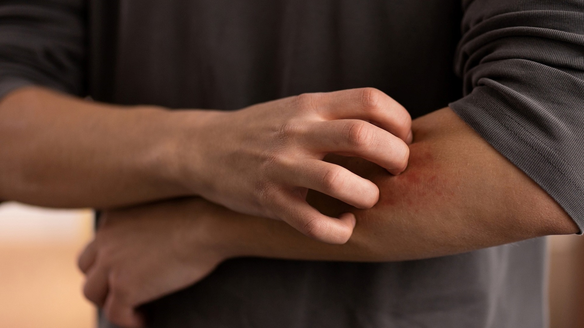Anti-histamínicos para dermatite atópica: o que dizem as evidências?
