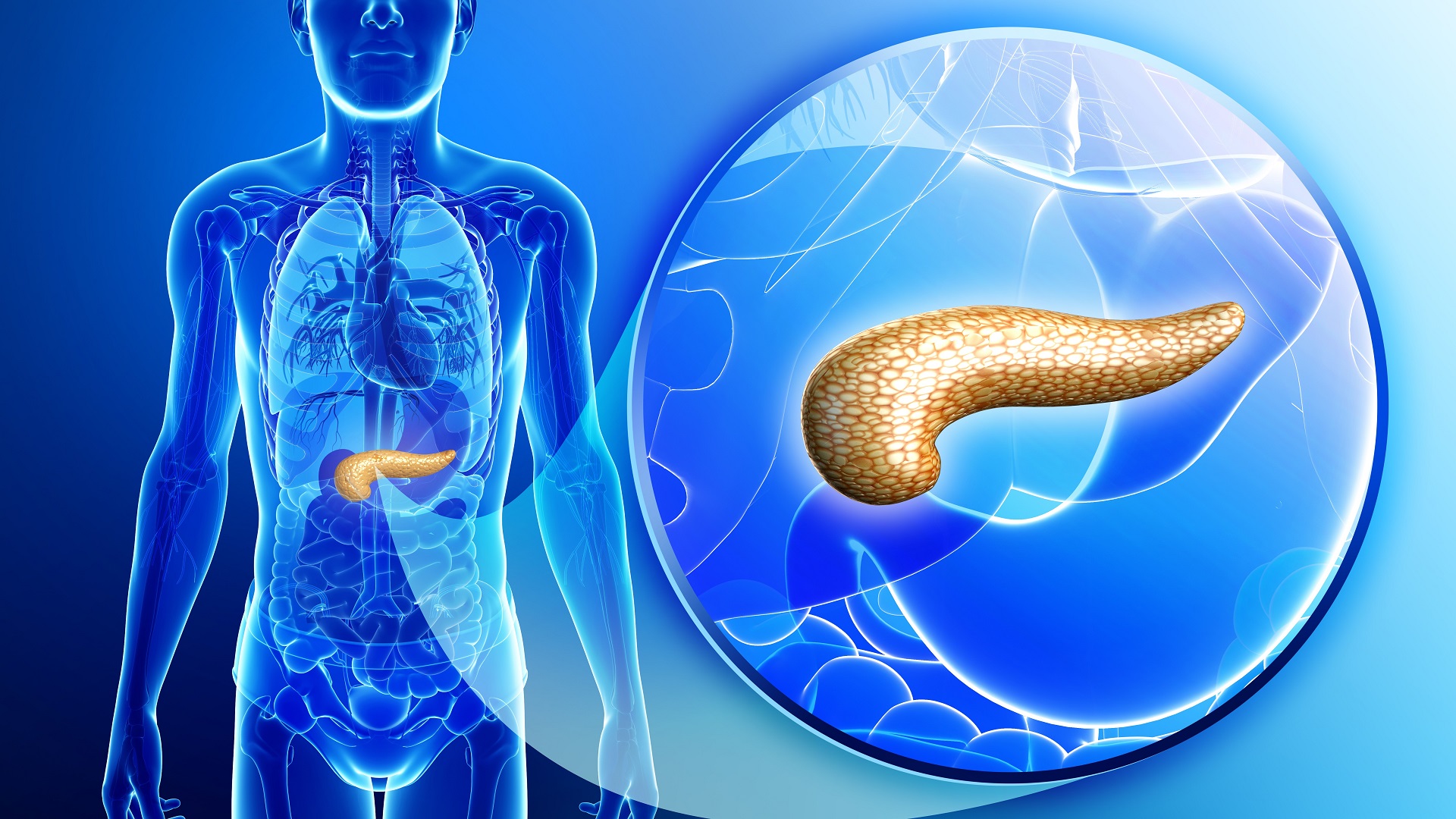 FDA aprova terapia inédita para câncer pancreático metastático
