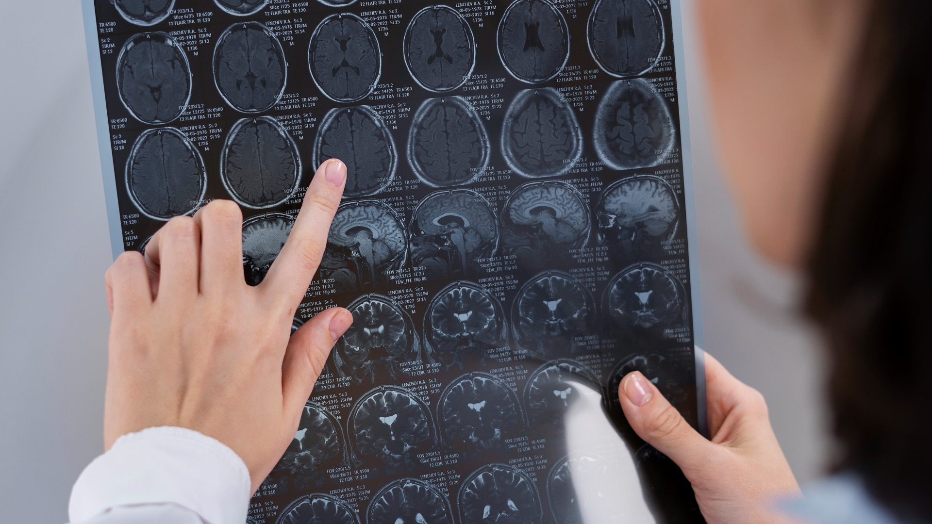 Craniectomia descompressiva profilática no hematoma epidural extenso