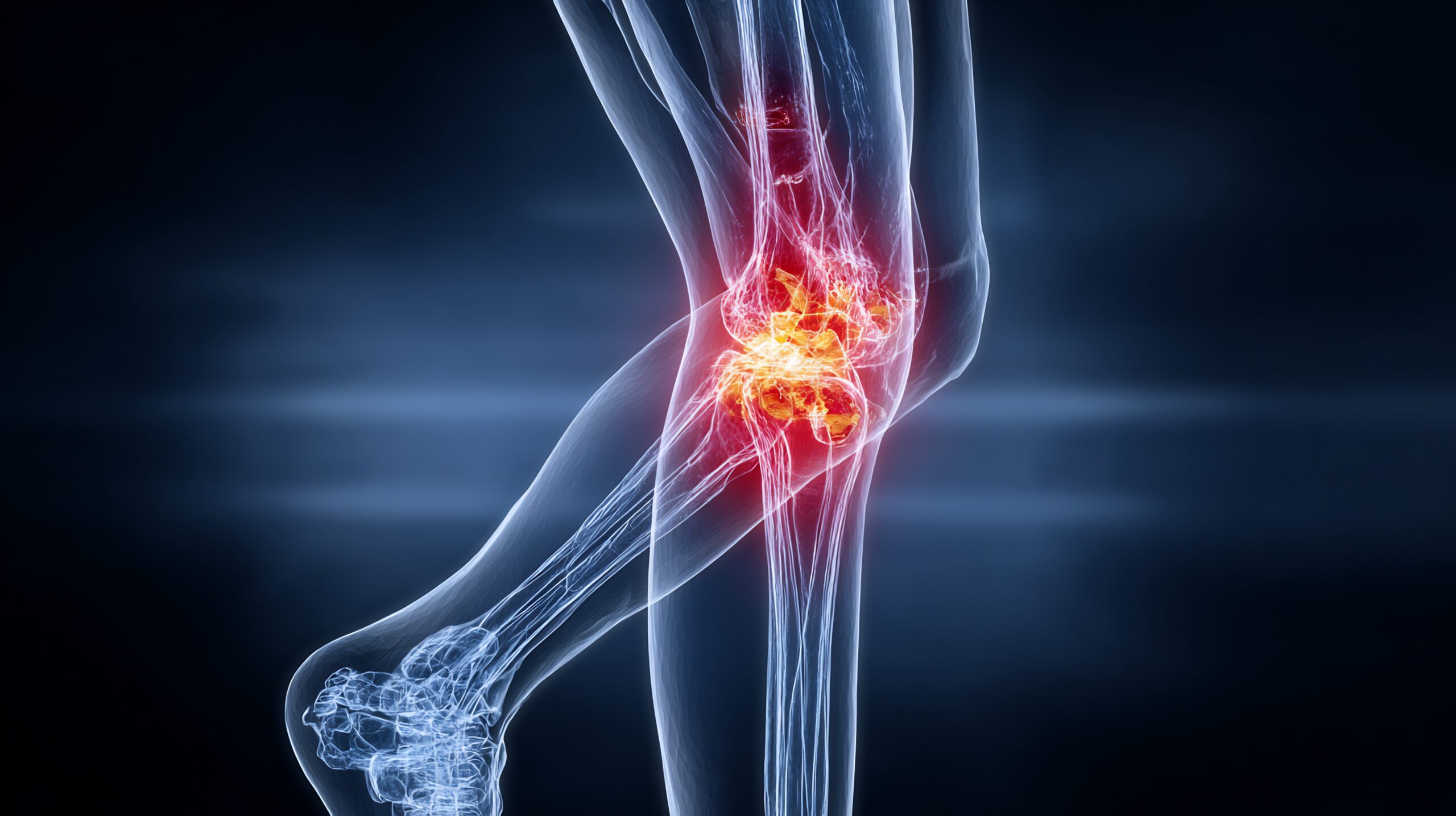 Ilustração demonstração caso de osteosarcoma na região do joelho